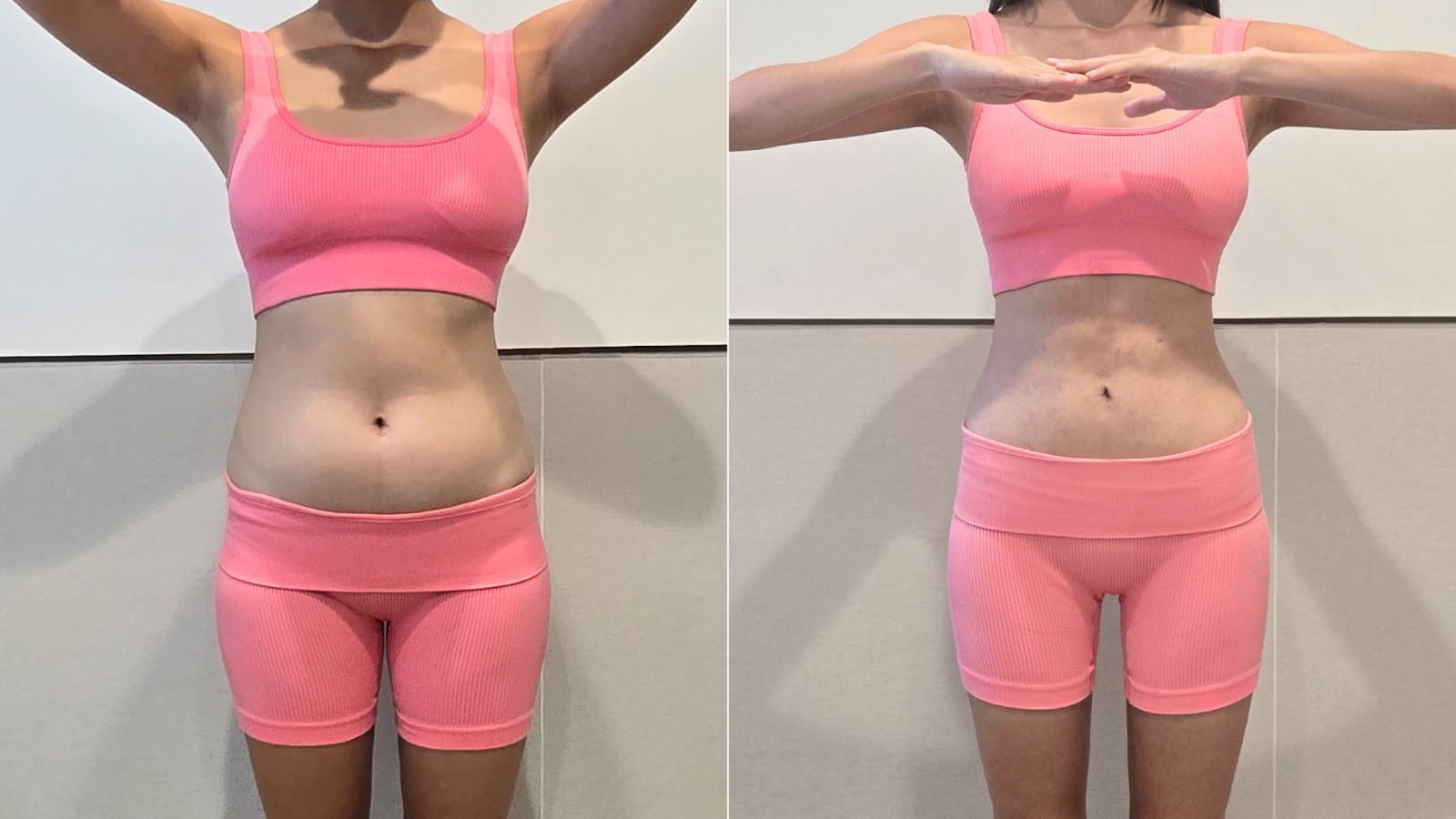 Fact or Myth: You Can Gain Weight Again After Liposuction?