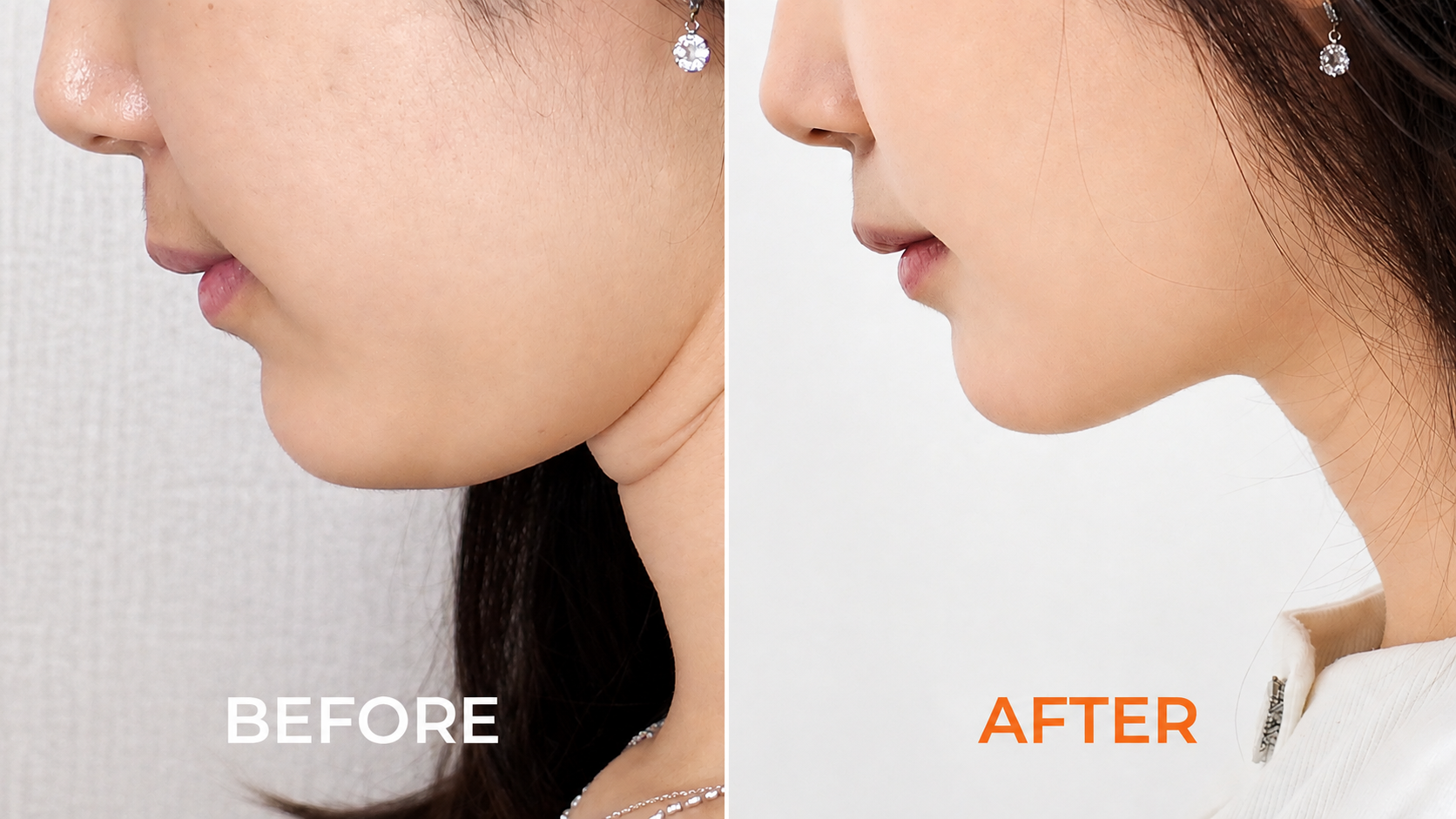 Can Double Chin Be Removed Permanently? Explore Your Treatment Options