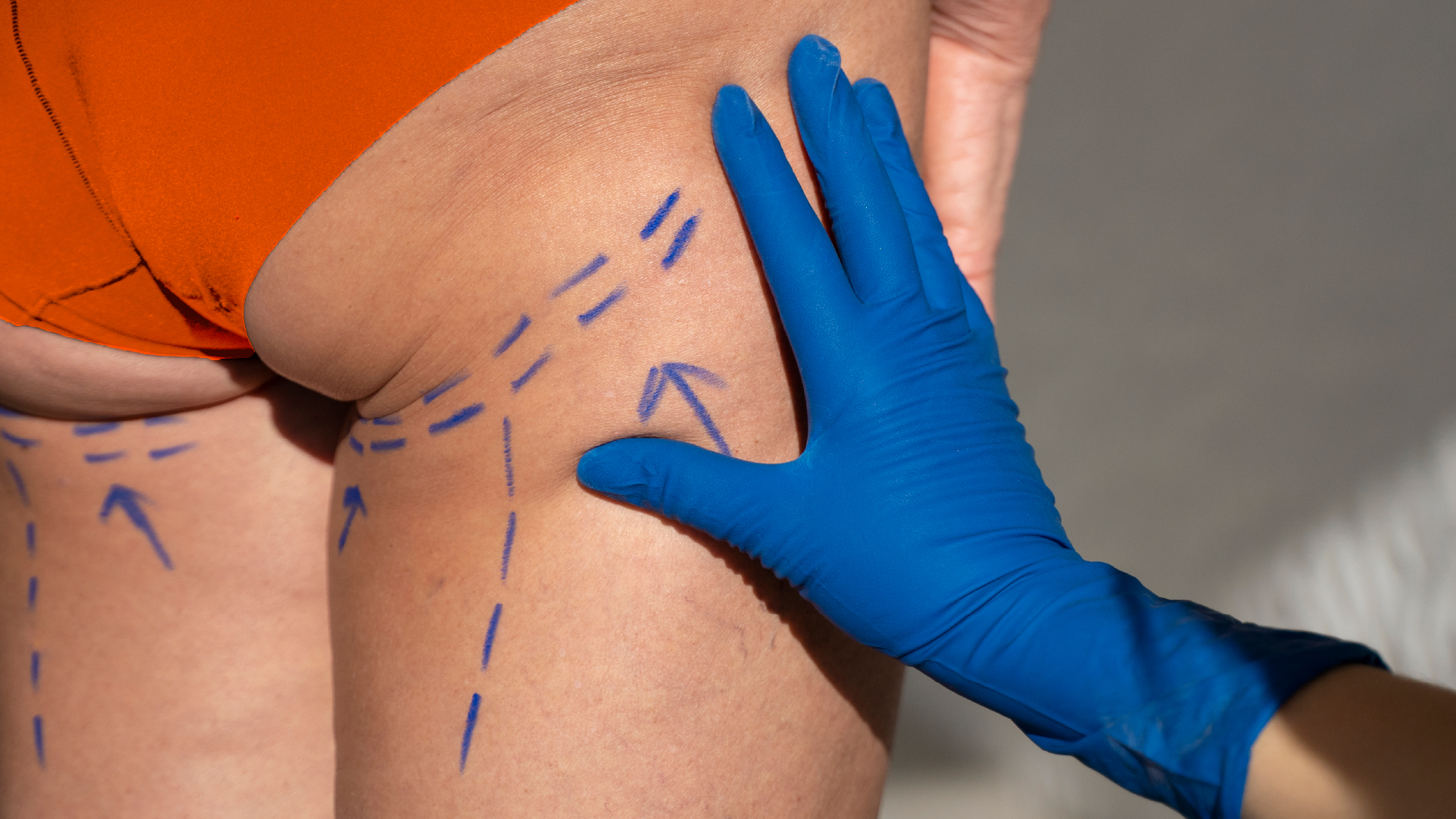 A Solution for Loose, Sagging Thigh Skin: Thighplasty