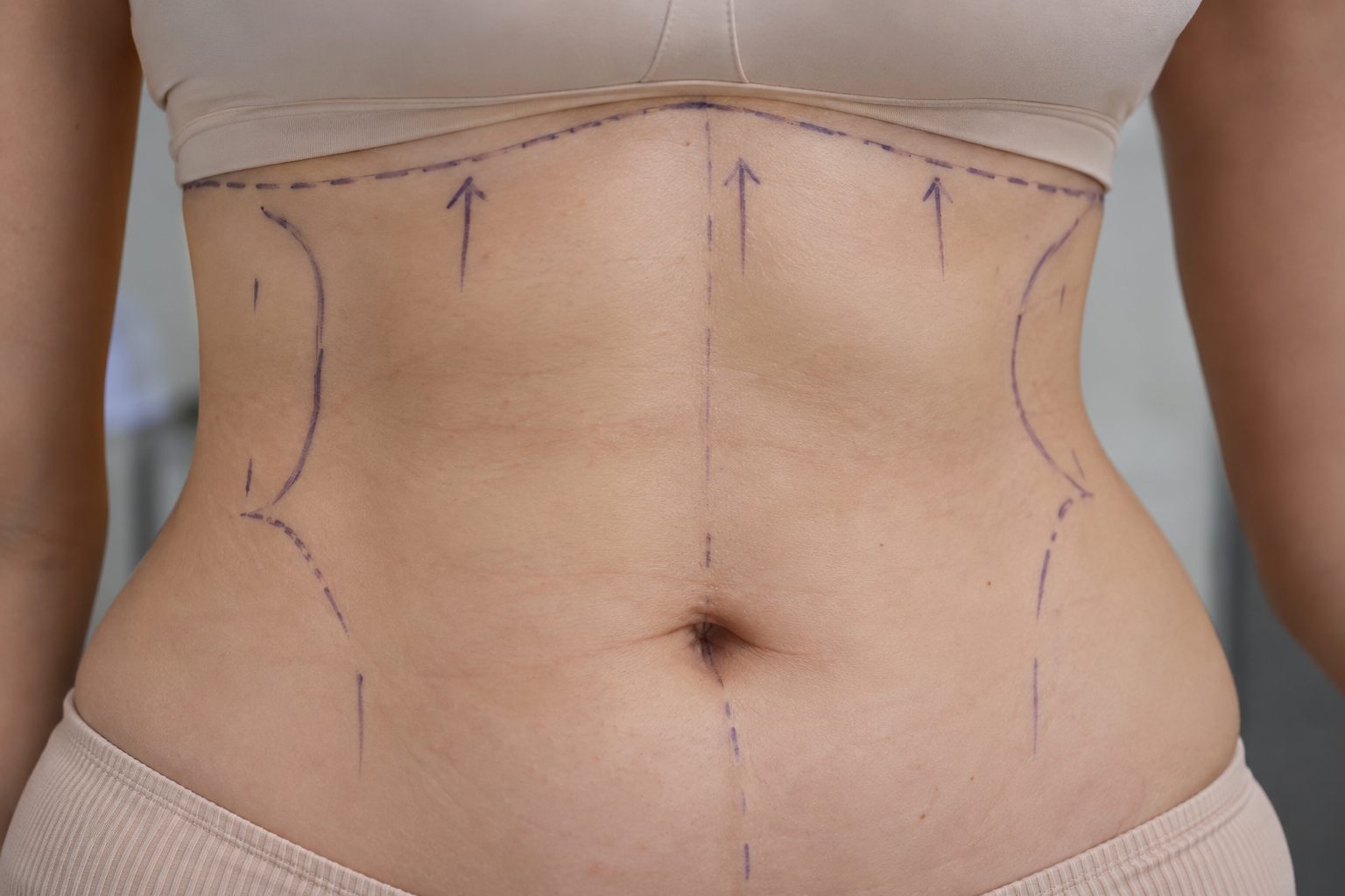Reverse Tummy Tuck: A Solution for the Upper Abdomen