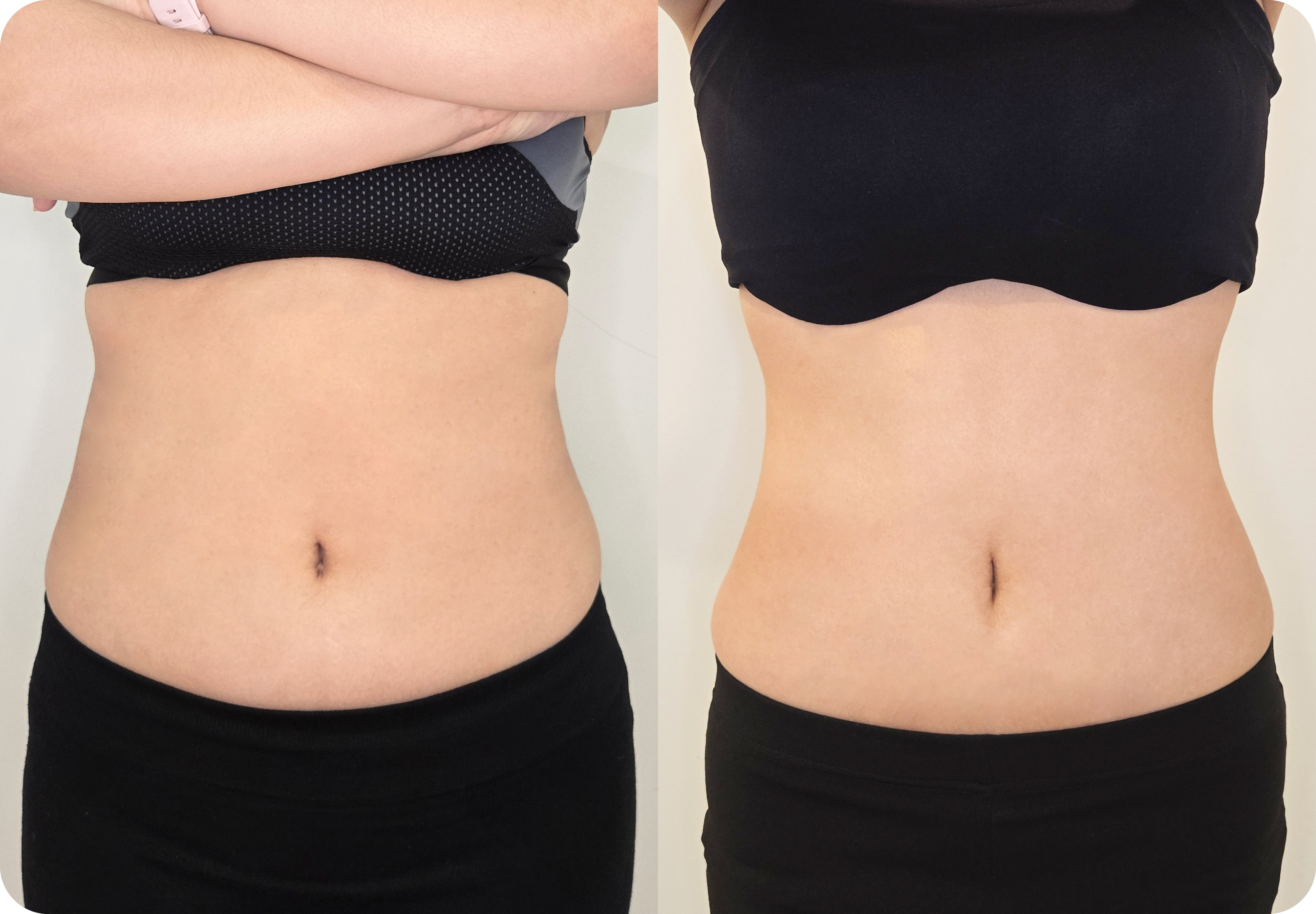 LAMS before and after result 1 at akasia 365mc