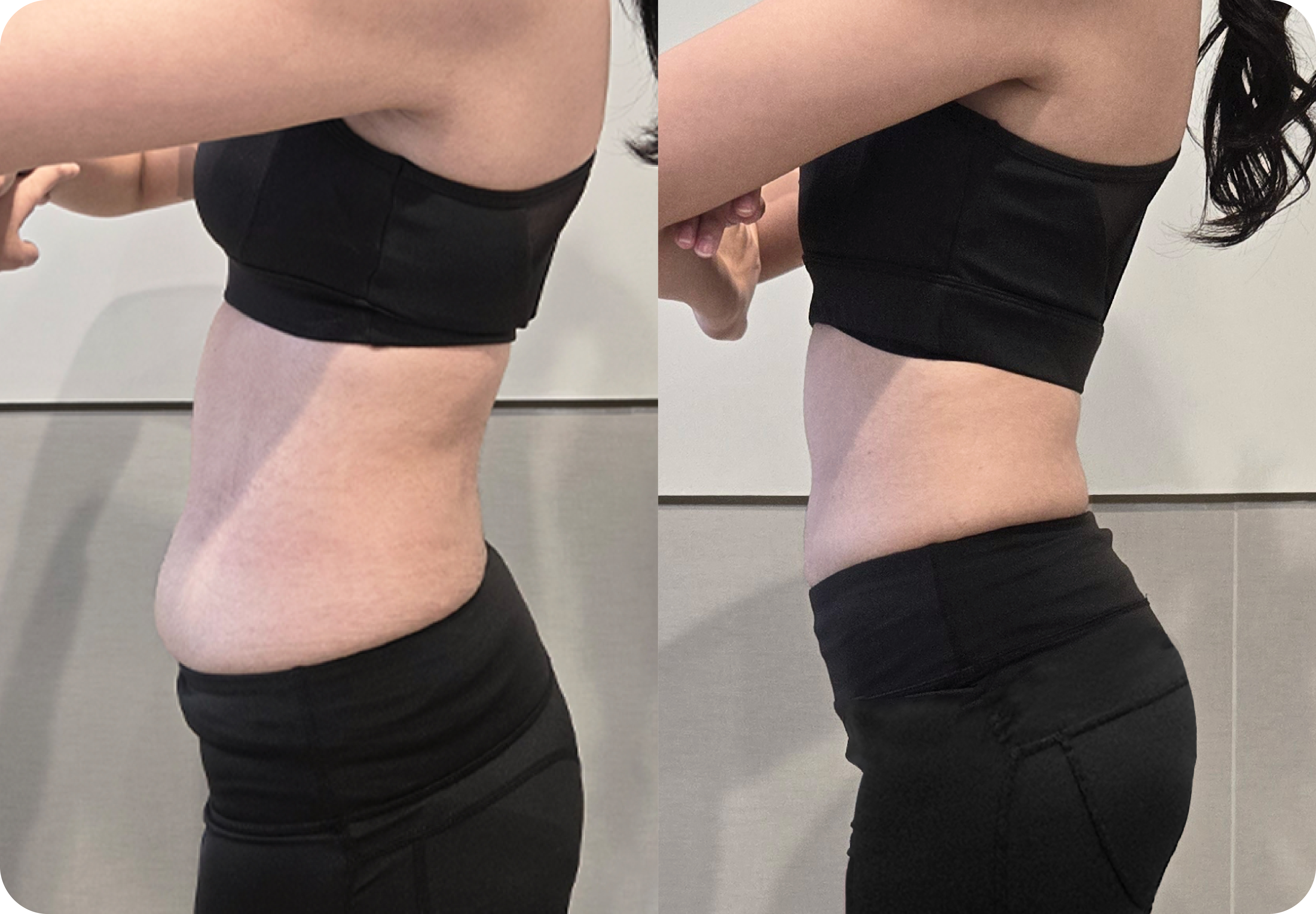 LAMS before and after result 4 at akasia 365mc