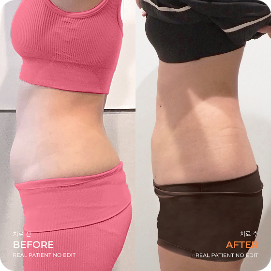 Abdomen liposuction before and after 2 at akasia 365mc