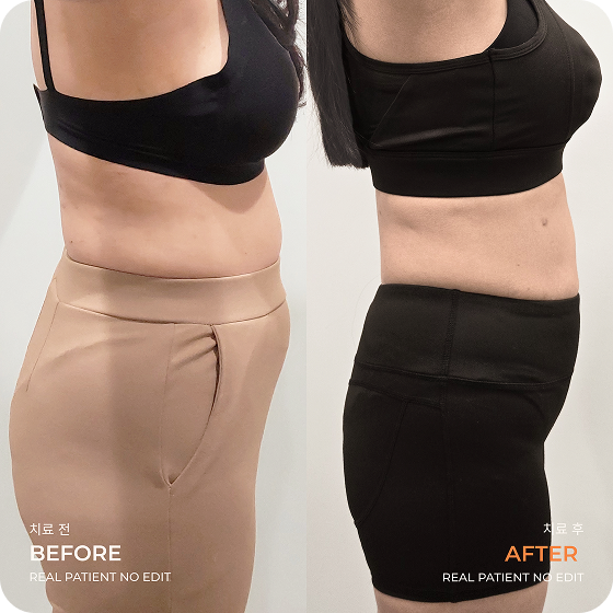 Abdomen liposuction before and after 3 at akasia 365mc