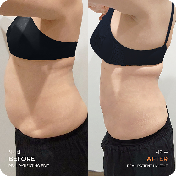 Abdomen liposuction before and after 4 at akasia 365mc