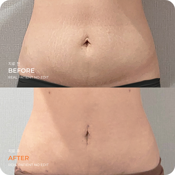 Abdomen liposuction before and after 1 at akasia 365mc