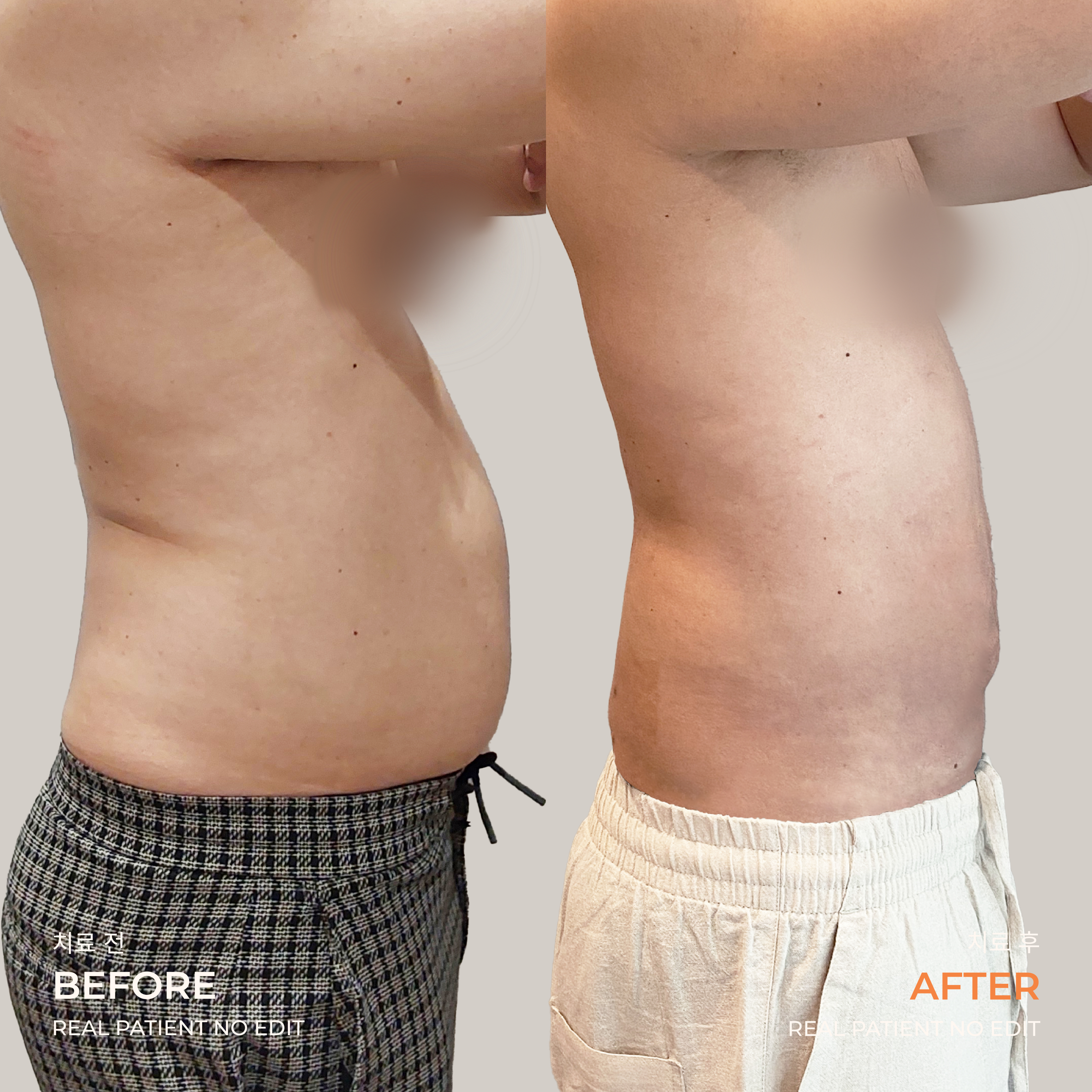 Abdomen liposuction before and after 5 at akasia 365mc
