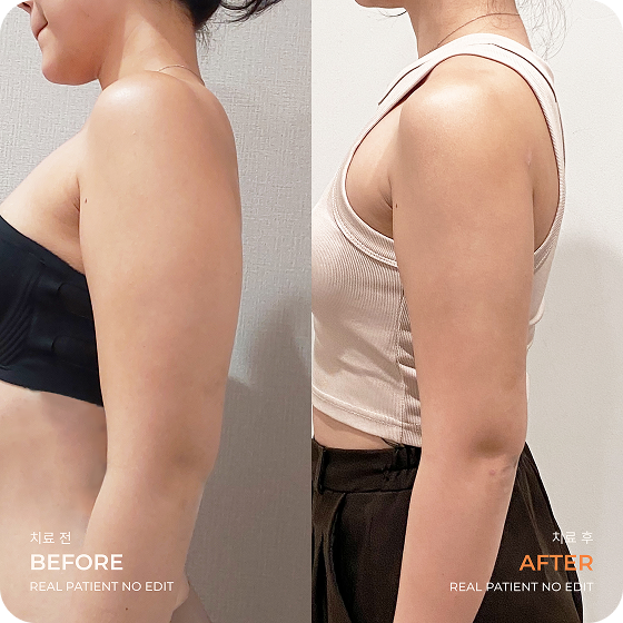 Arm liposuction before and after 3 at akasia 365mc