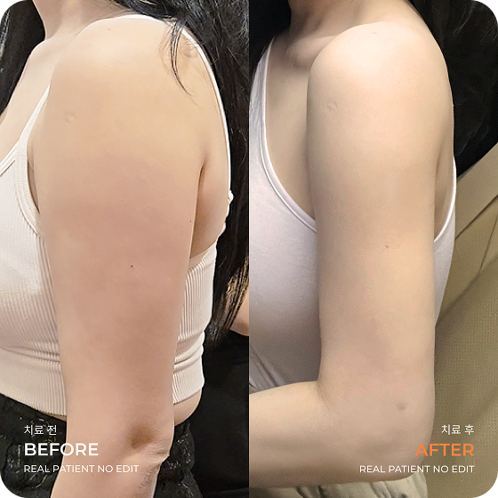 Arm liposuction before and after 4 at akasia 365mc