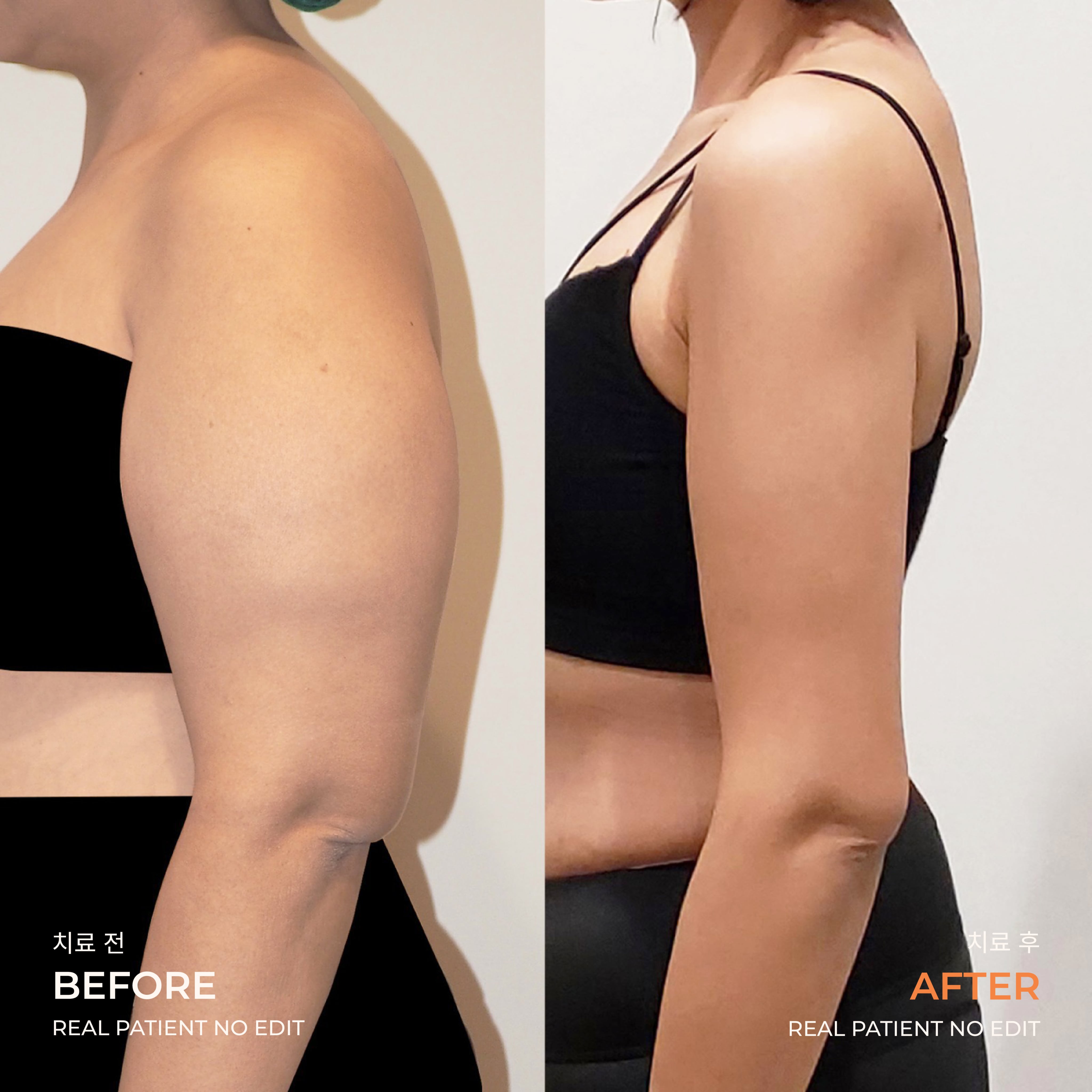 Arm liposuction before and after 5 at akasia 365mc