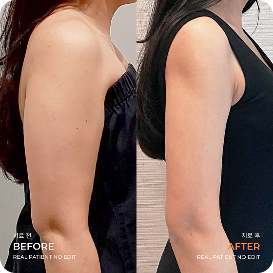 Arm liposuction before and after 1 at akasia 365mc