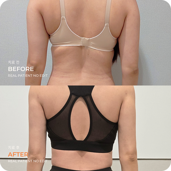 Back liposuction before and after 2 at akasia 365mc