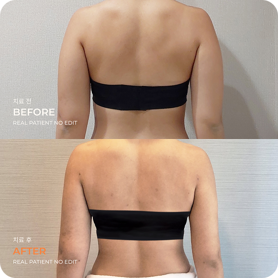 Back liposuction before and after 3 at akasia 365mc