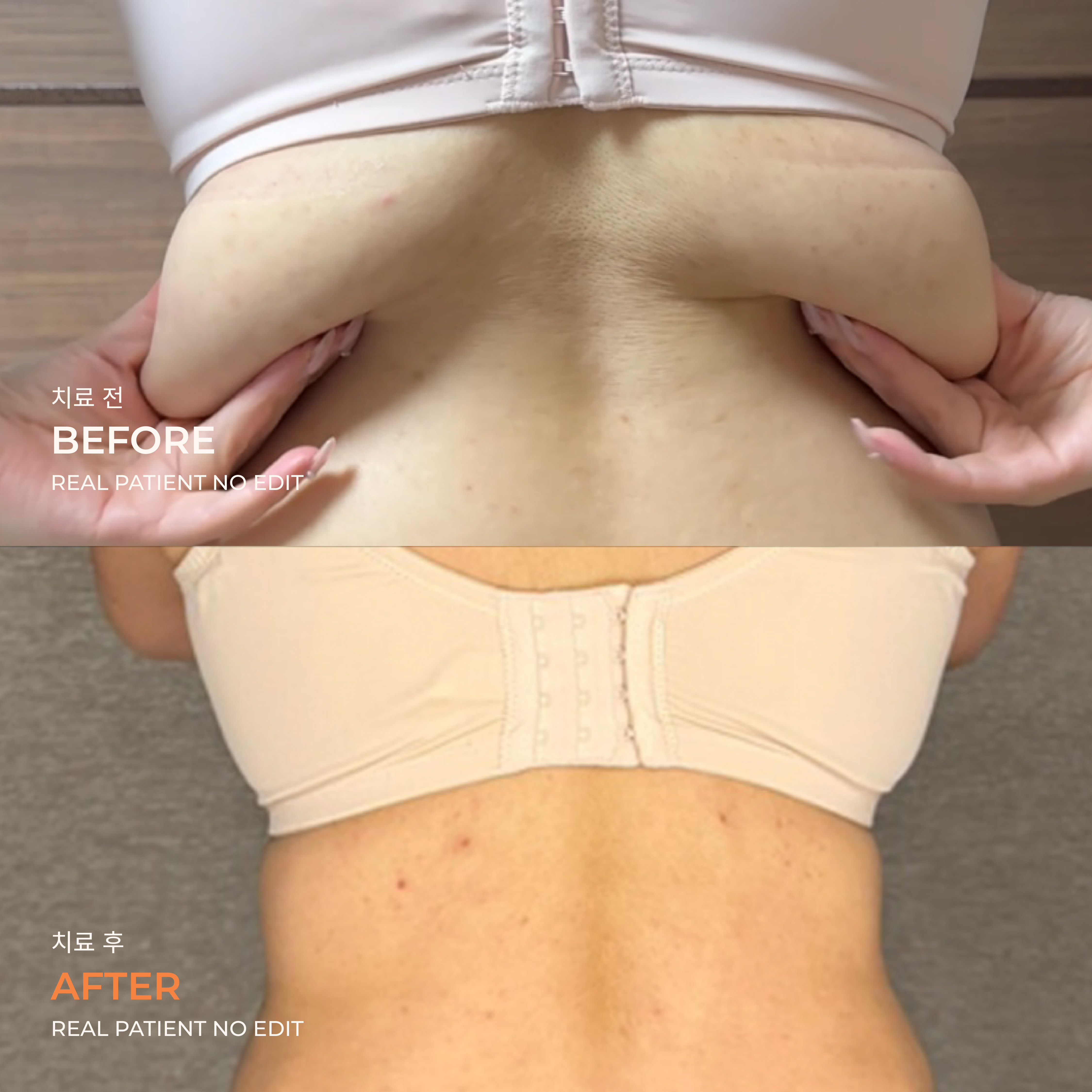 Back liposuction before and after 4 at akasia 365mc