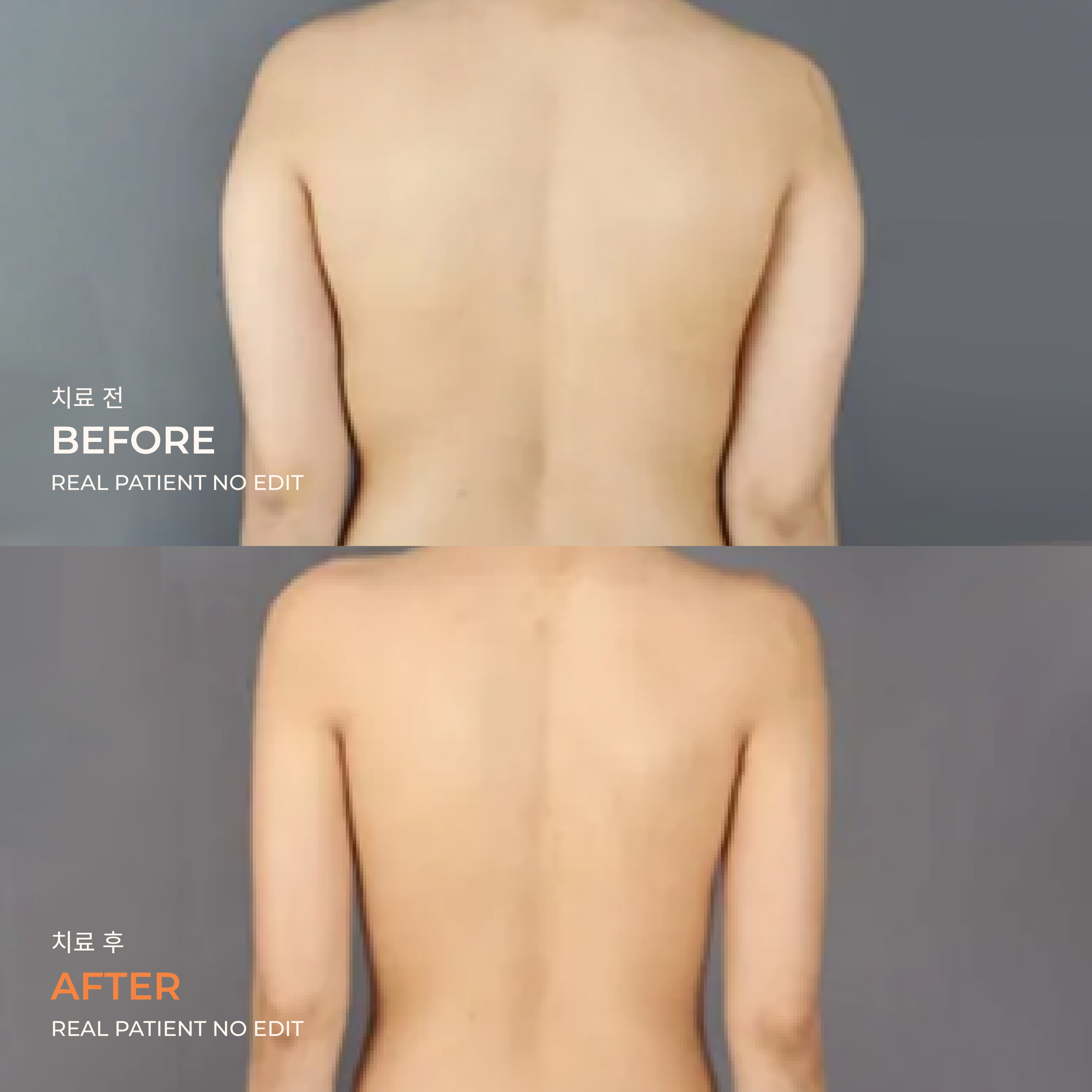 Back liposuction before and after 5 at akasia 365mc