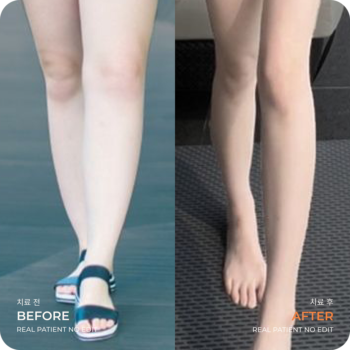 Calves liposuction before and after 2 at akasia 365mc
