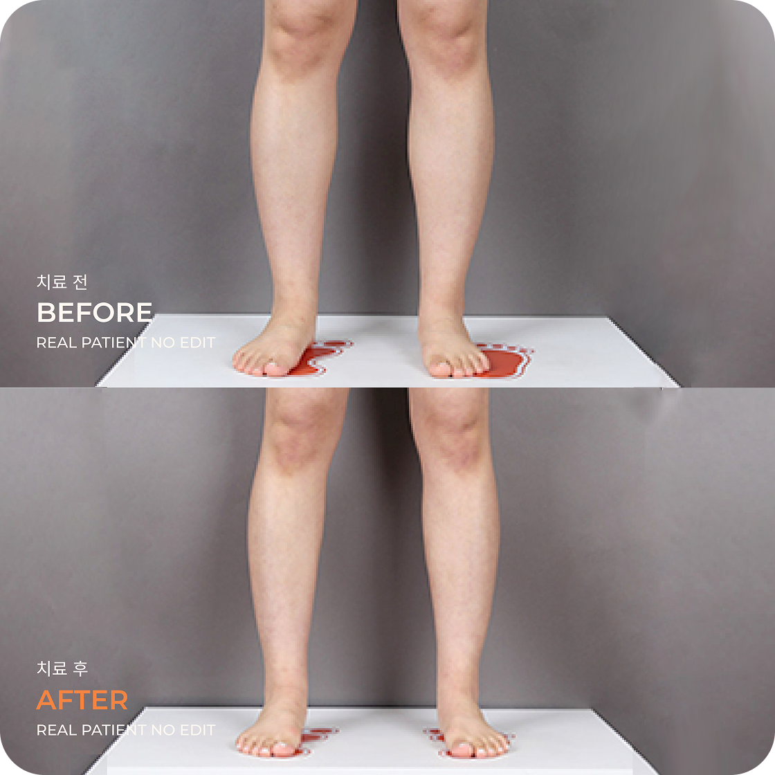 Calves liposuction before and after 3 at akasia 365mc