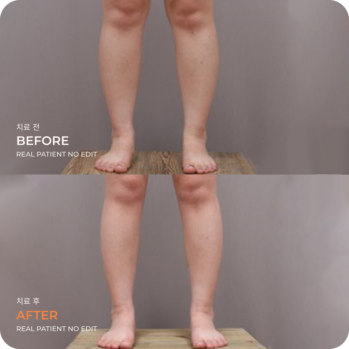 Calves liposuction before and after 4 at akasia 365mc