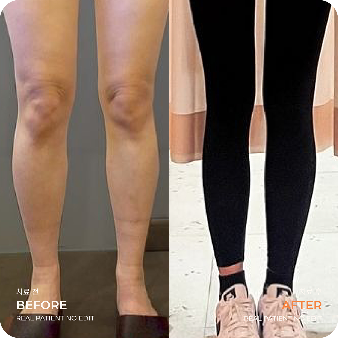 Calves liposuction before and after 1 at akasia 365mc