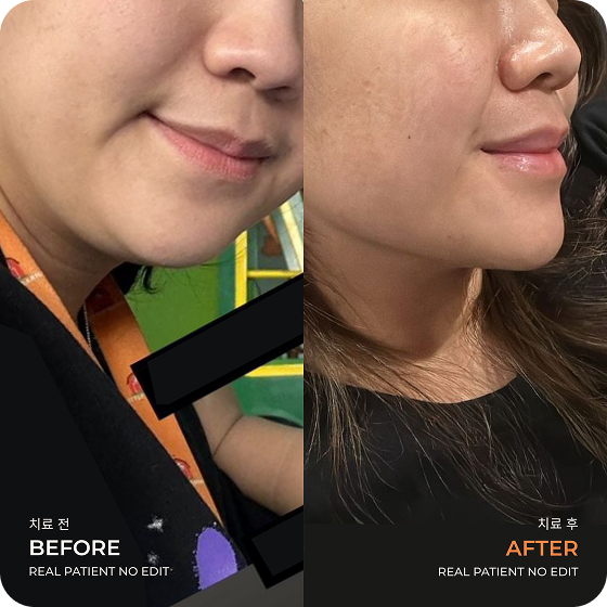 Double chin liposuction before and after 2 at akasia 365mc