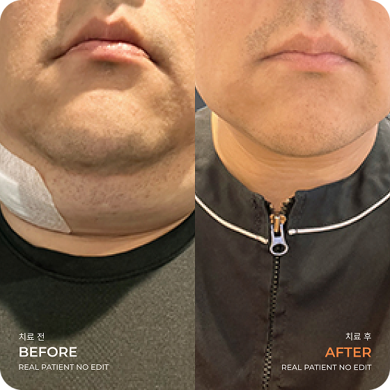Double chin liposuction before and after 3 at akasia 365mc