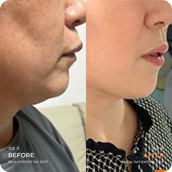 Double chin liposuction before and after 4 at akasia 365mc