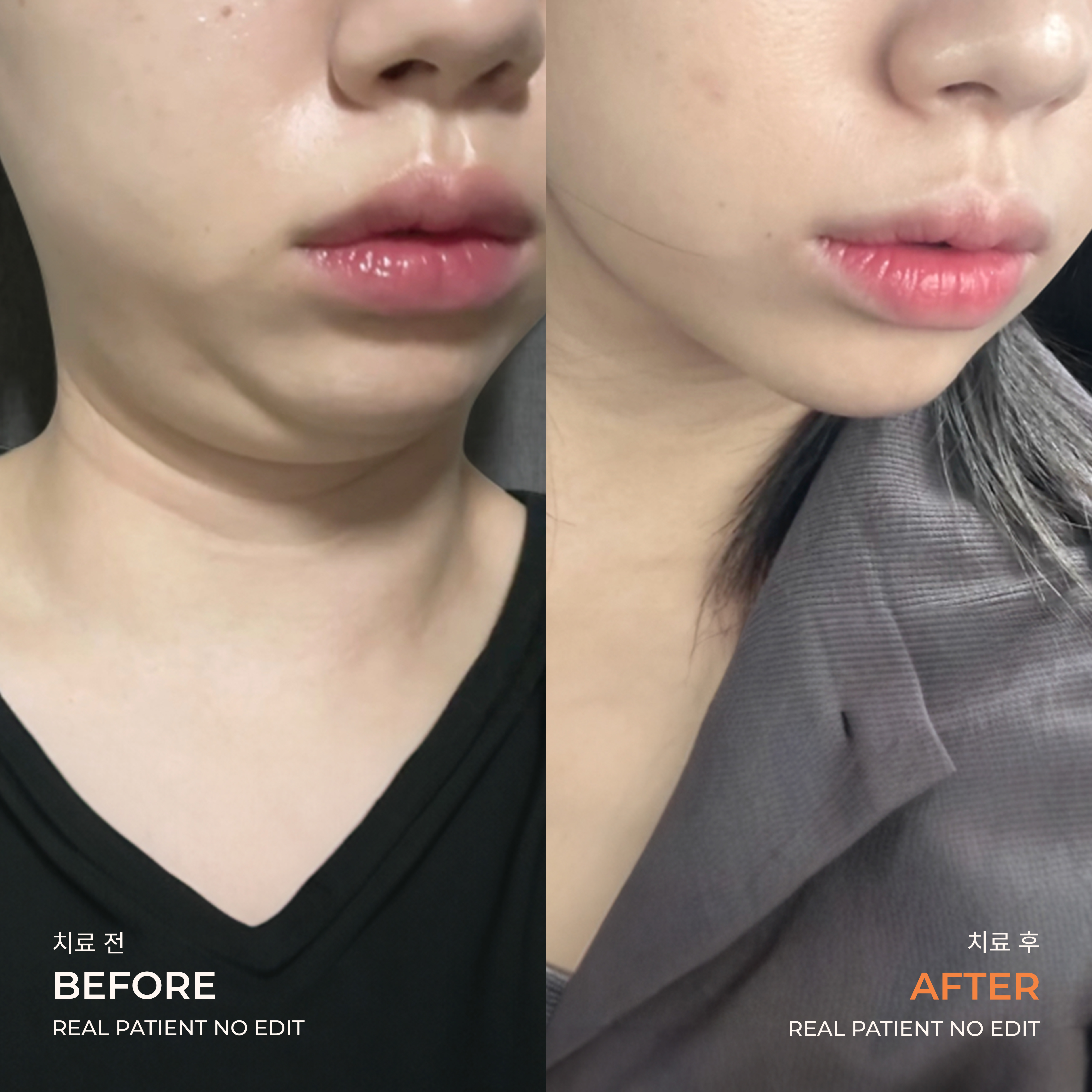 Double chin liposuction before and after 5 at akasia 365mc