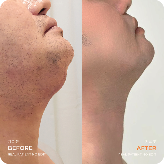 Double chin liposuction before and after 1 at akasia 365mc