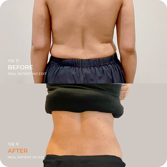 Love handle liposuction before and after 2 at akasia 365mc