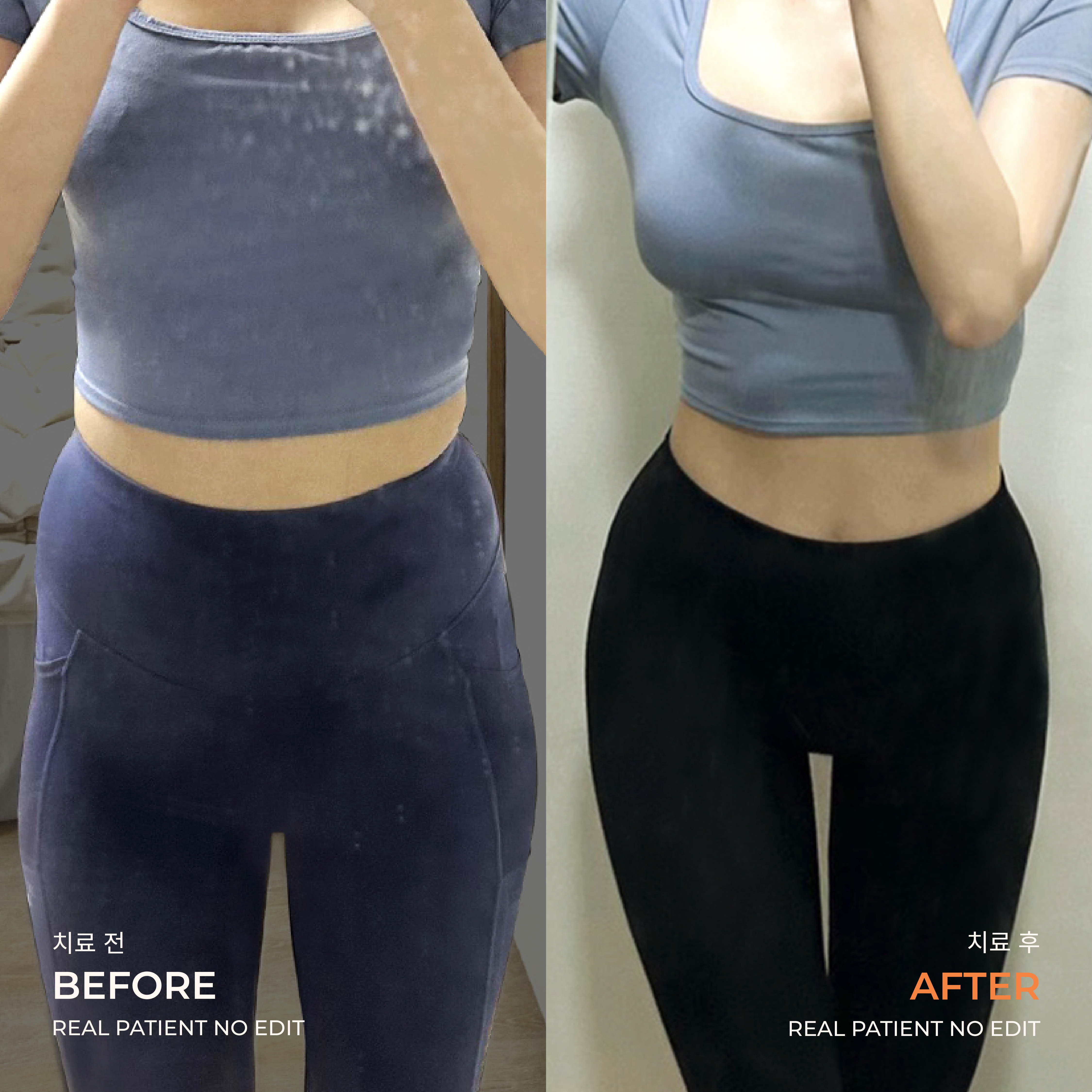 Love handle liposuction before and after 3 at akasia 365mc