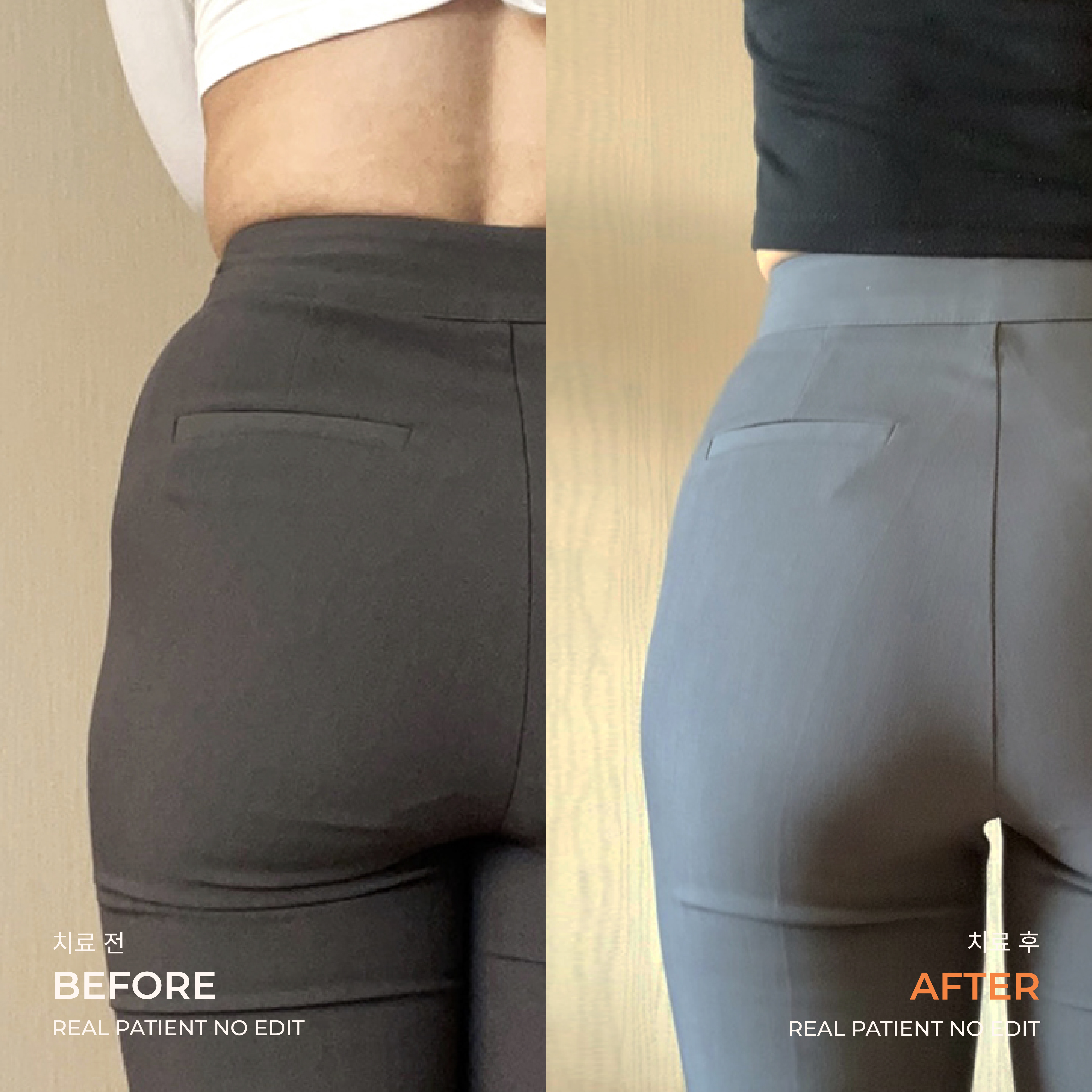 Love handle liposuction before and after 4 at akasia 365mc