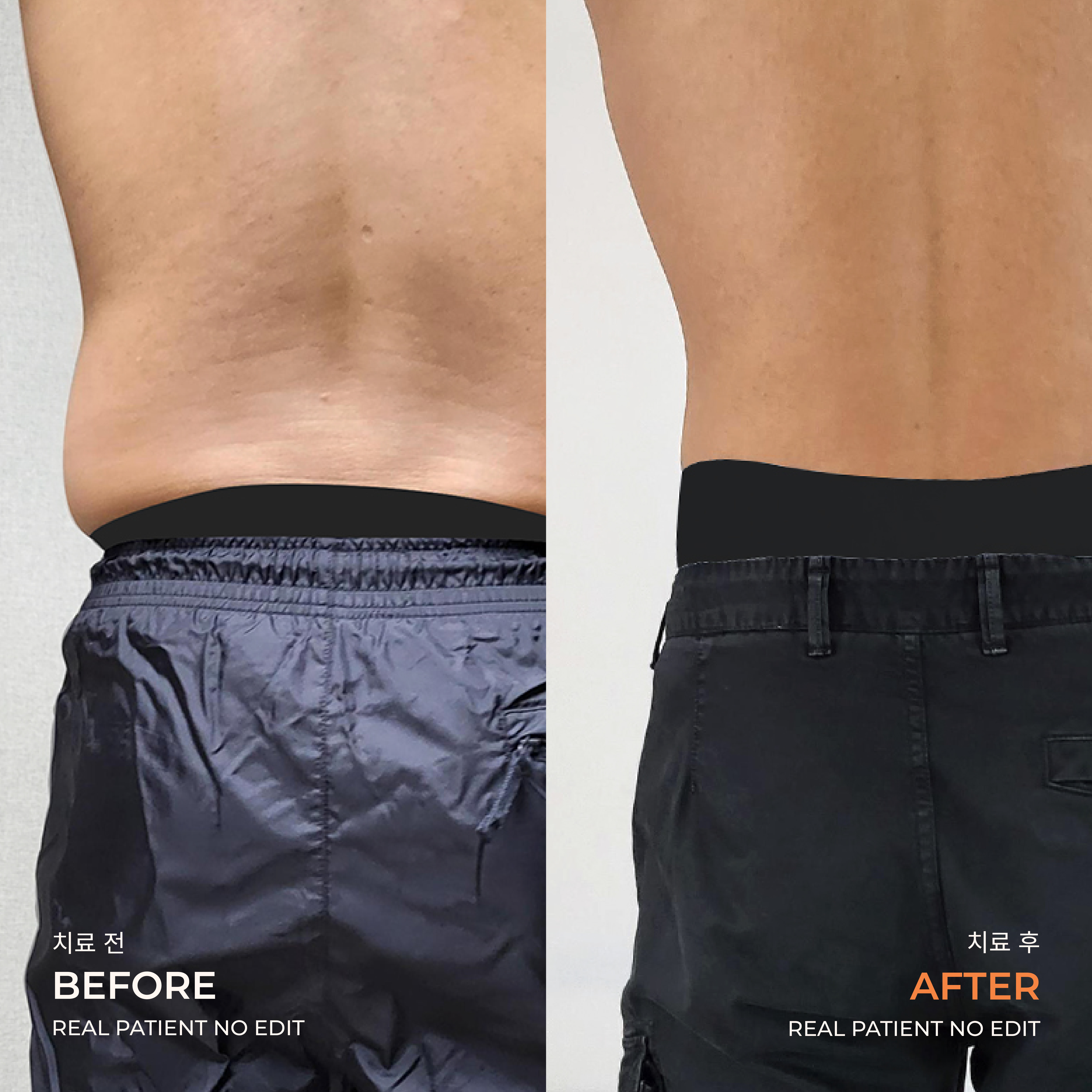 Love handle liposuction before and after 5 at akasia 365mc