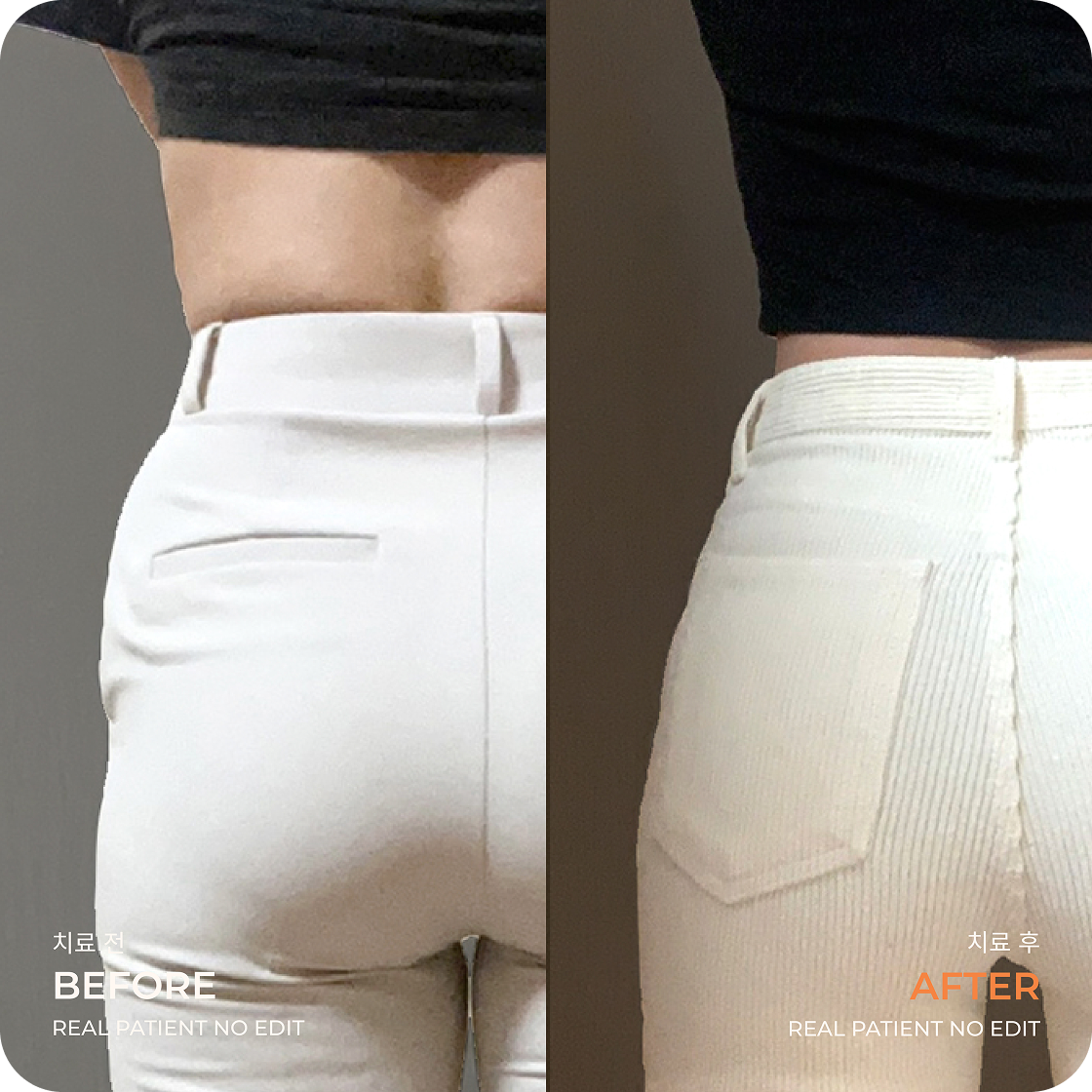 Love handle liposuction before and after 1 at akasia 365mc