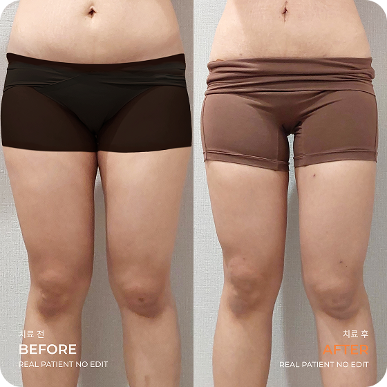 Thigh liposuction before and after 2 at akasia 365mc