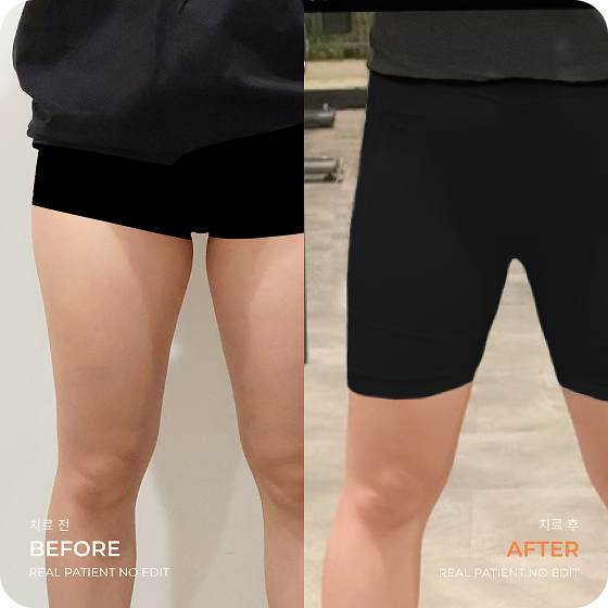 Thigh liposuction before and after 3 at akasia 365mc