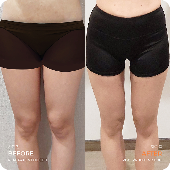 Thigh liposuction before and after 4 at akasia 365mc
