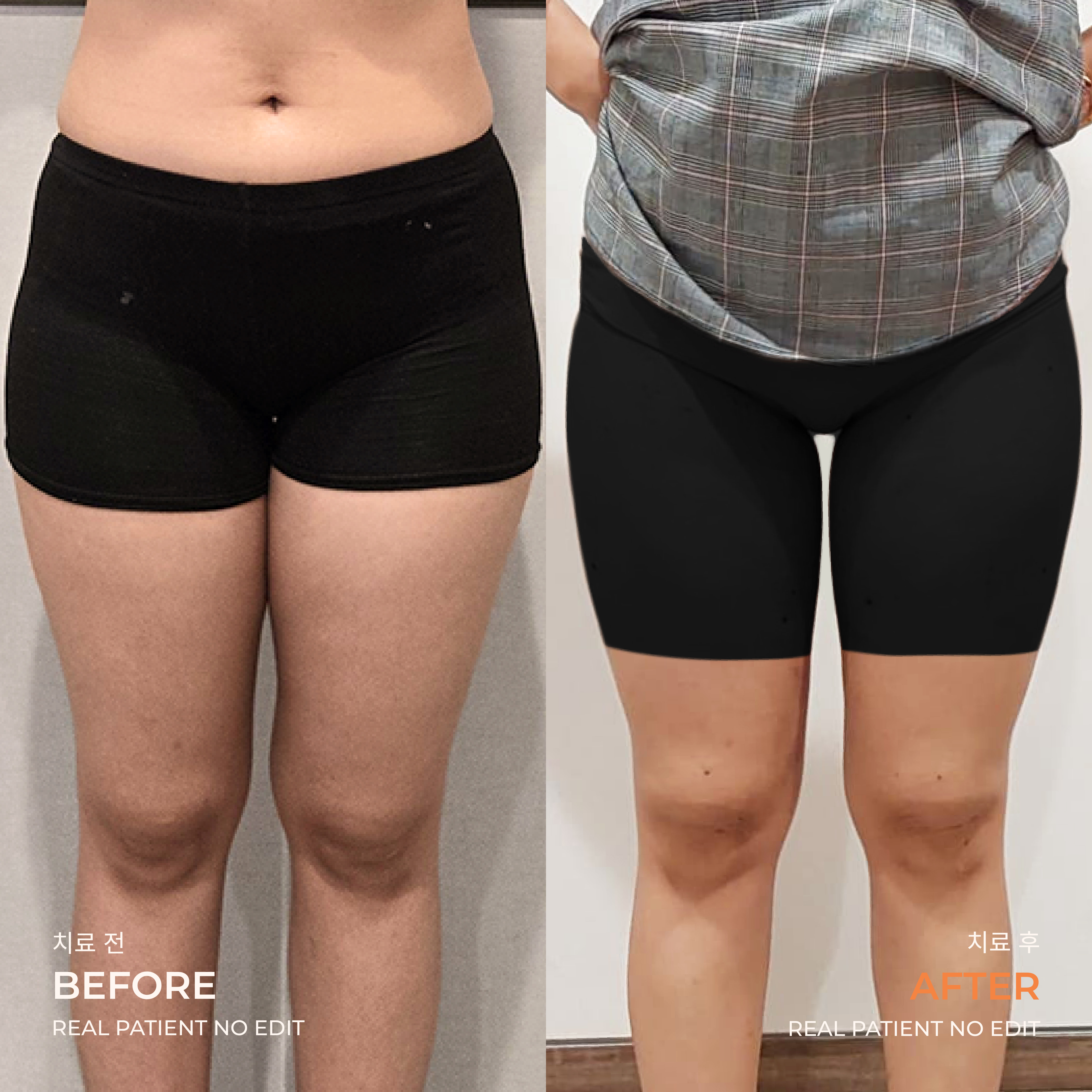 Thigh liposuction before and after 5 at akasia 365mc