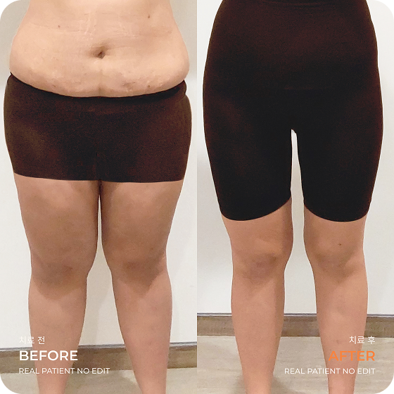 Thigh liposuction before and after 1 at akasia 365mc