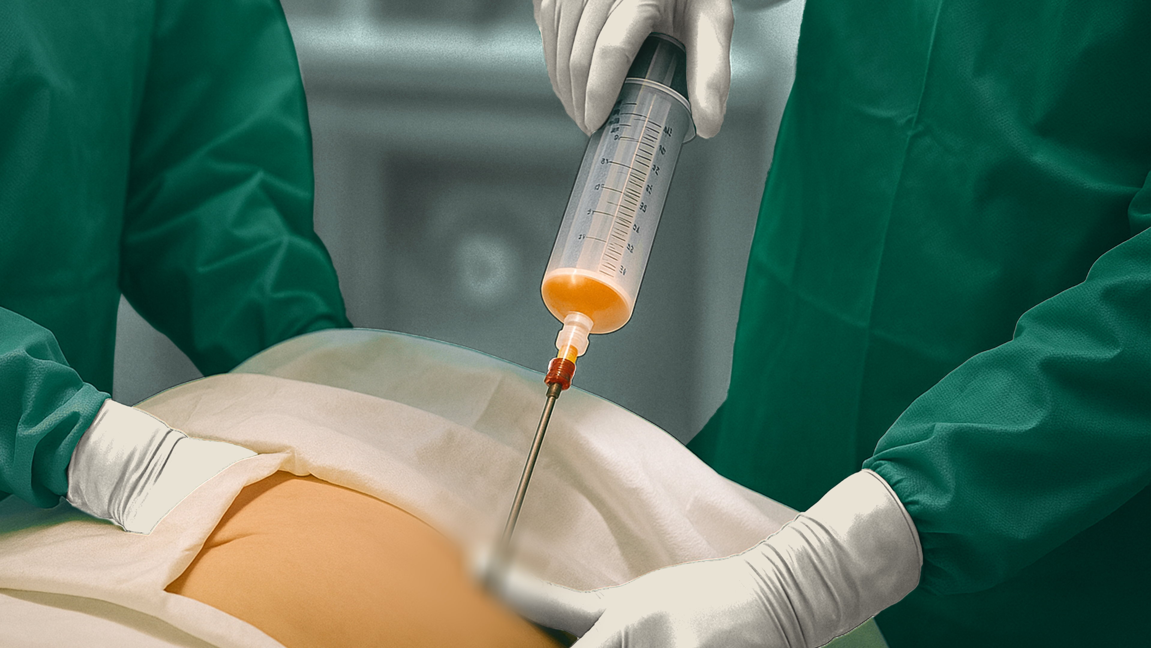 Fat Graft treatment at akasia 365mc